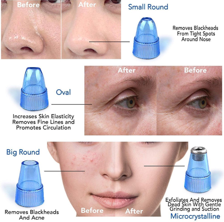 Vaccum blackhead cleansor